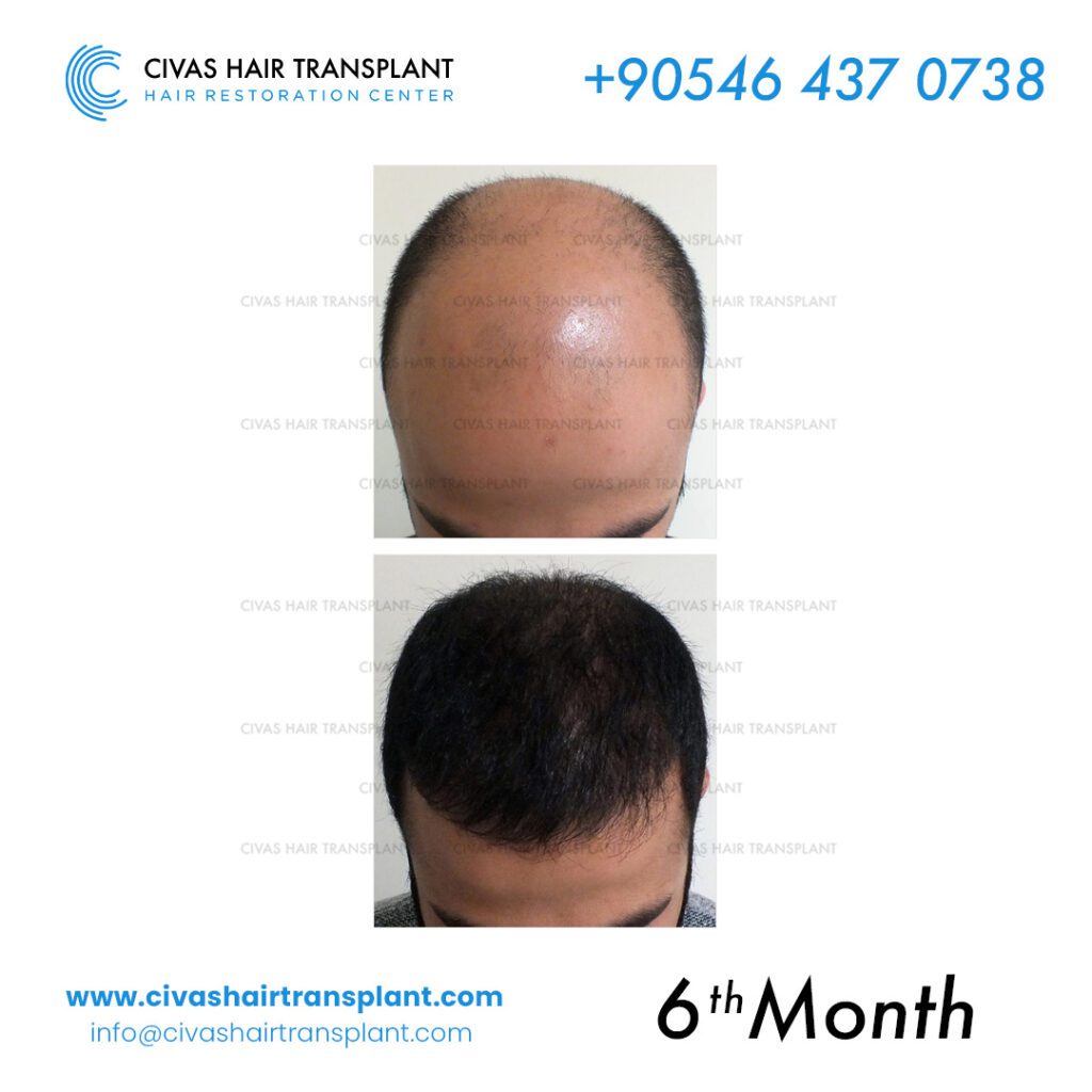 Dr. Ekrem Civas – Hair Transplant Expert before-after