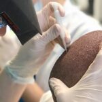 advanced-hair-clinic