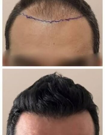 Dr. Sumer Hair Clinic, London