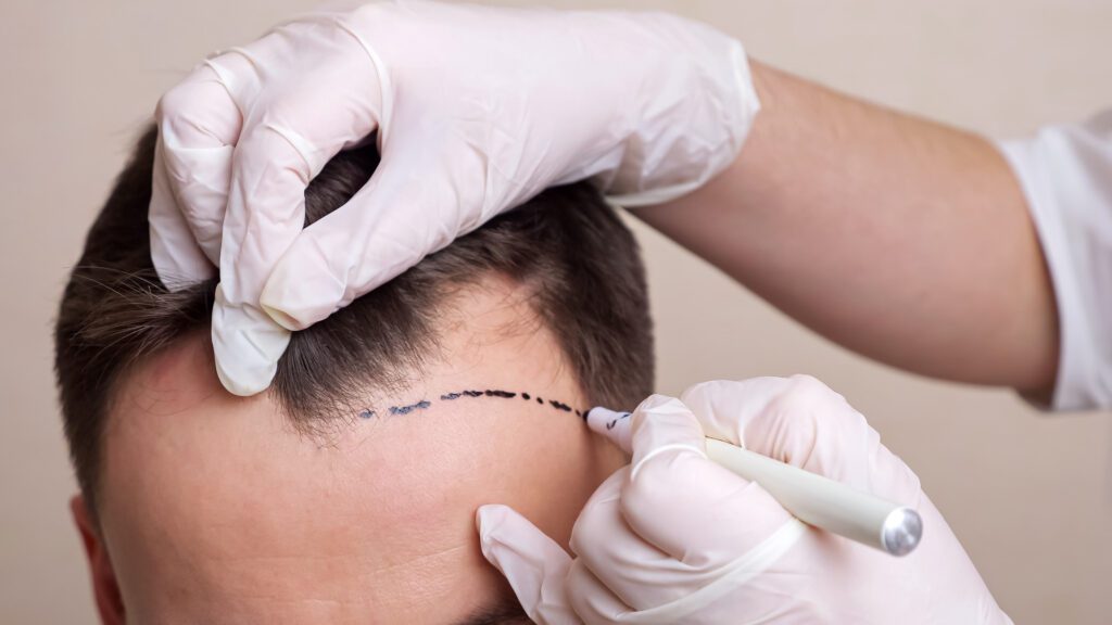 Justin Bieber hair transplant