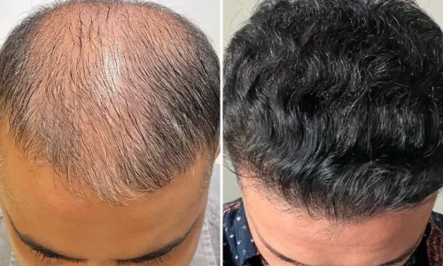 Before and after FUE hair transplant by Dr. Felipe Pittella – natural hairline restoration with seamless results.