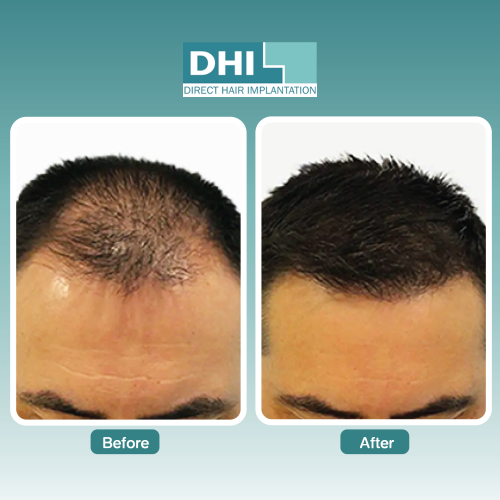 before-after-dhi-thailand