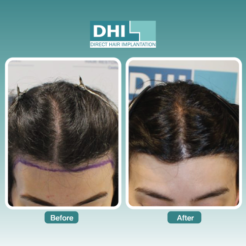 DHI Thailand – Bangkok Hair Restoration Experts