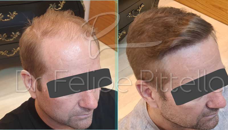 Beard and scalp hair transplant (BHT + FUE) before-and-after – improved density and natural-looking coverage."