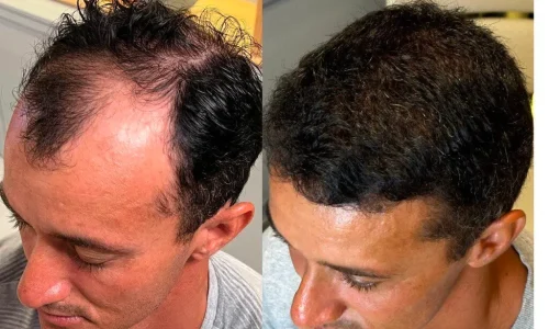 Gigasession hair transplant before-and-after – Dr. Felipe Pittella’s advanced technique for full scalp coverage.