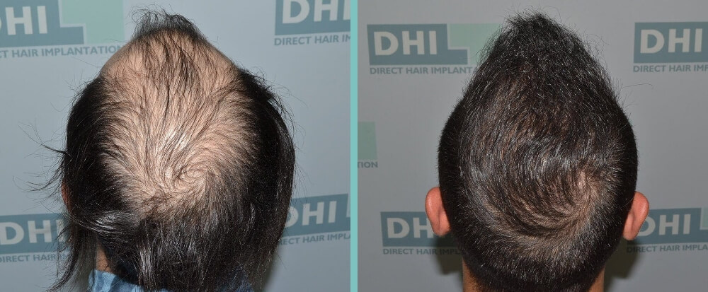 before-after-dhi