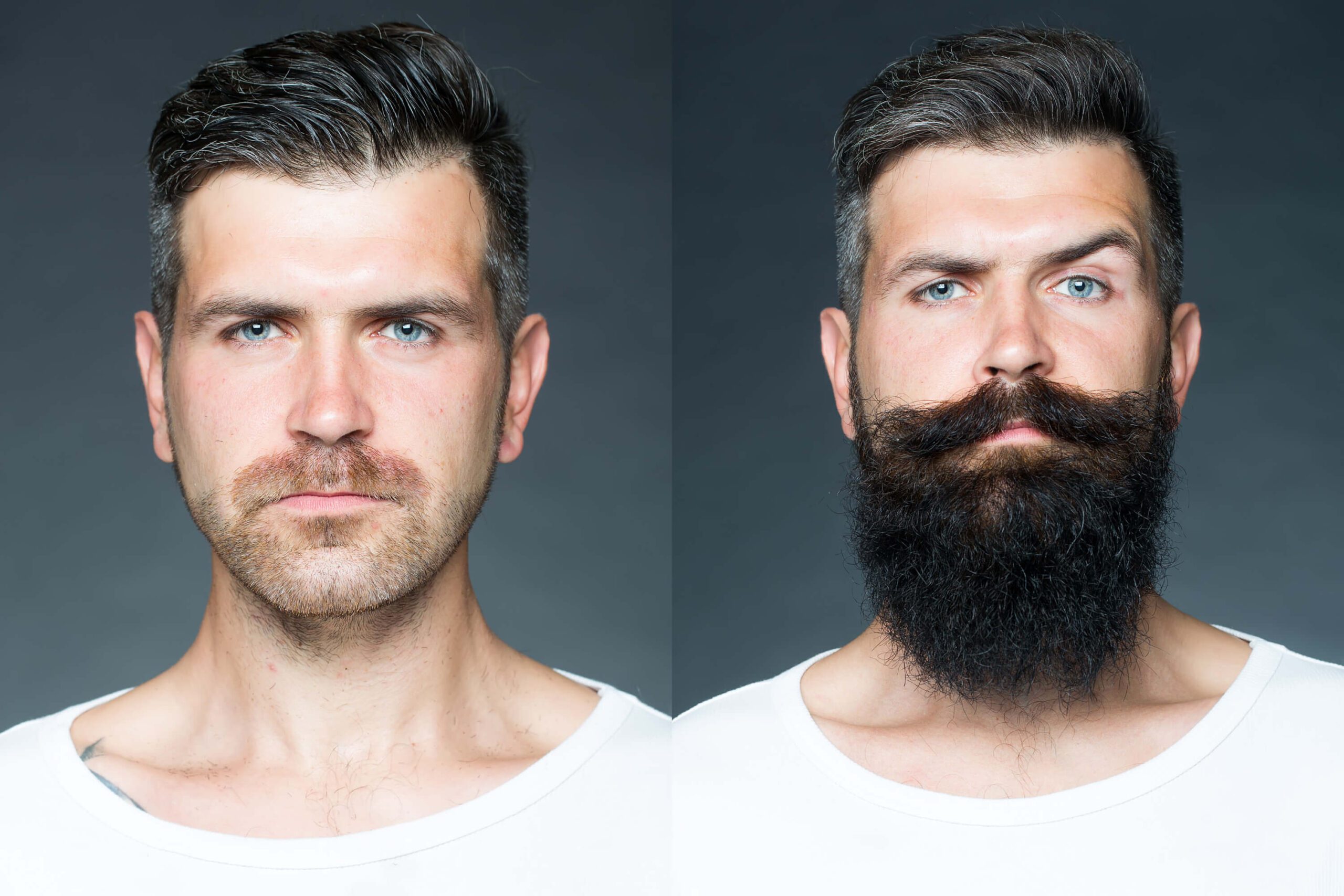 beard-transplant