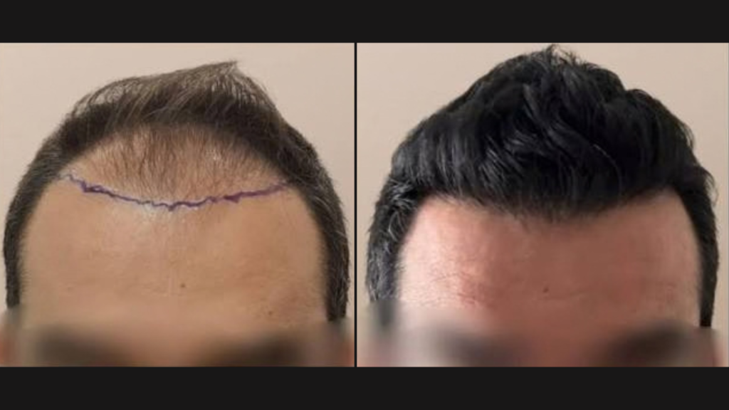 Dr Sumer Hair Clinic before and after hair transplant result