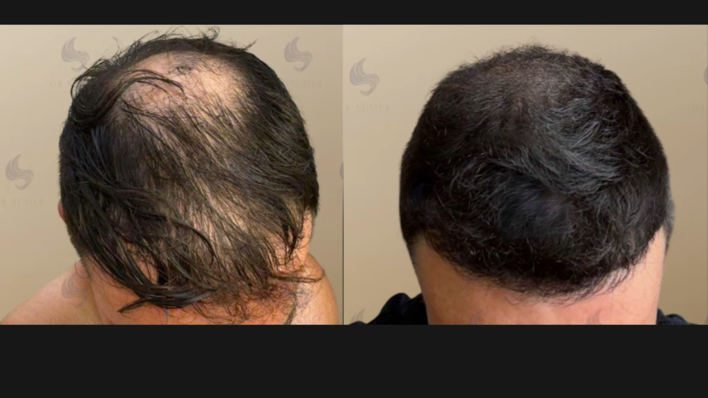 Dr Sumer Hair Transplant before and after result with natural hairline restoration