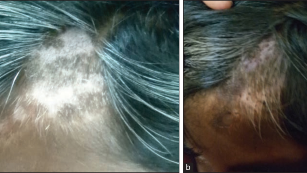 Scalp vitiligo before and after hair follicle transplantation showing repigmentation and hair restoration