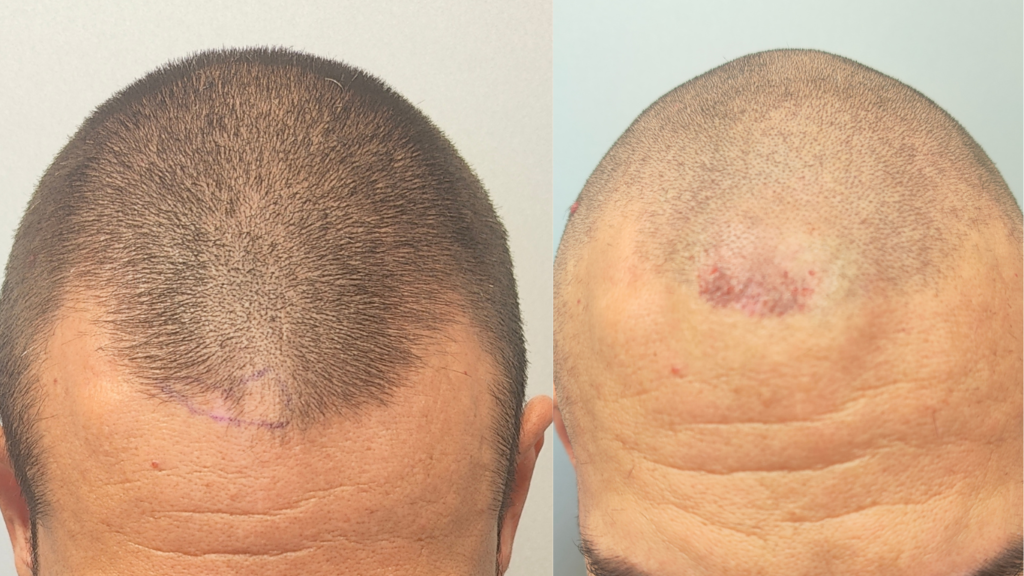 Follicular vitiligo with leukotrichia before and after hair transplantation