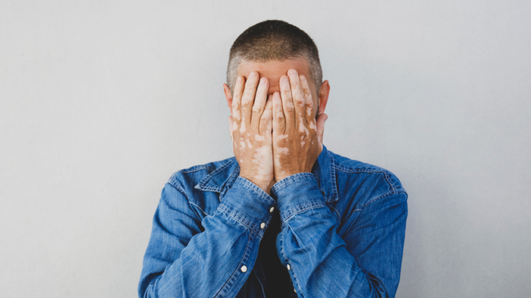 Man with vitiligo covering his face while considering a hair transplant for hair loss