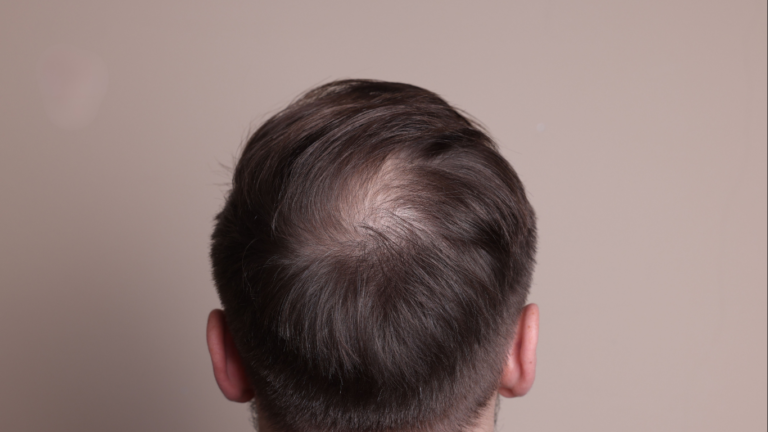 Male patient showing early signs of hairline recession according to the Norwood Scale