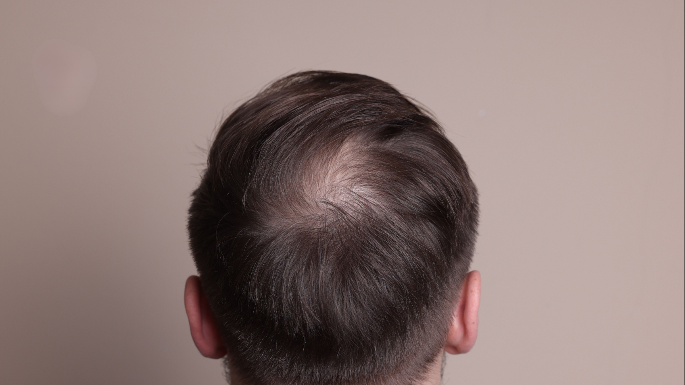 Male patient showing early signs of hairline recession according to the Norwood Scale