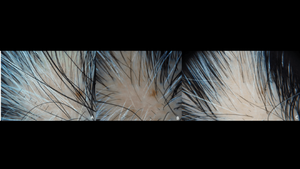 Close-up of hair shafts showing black pigment returning at the roots in previously white hairs.